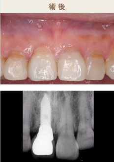 インプラント治療 前歯部 術後