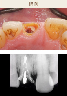 インプラント治療 前歯部 術前